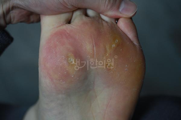 사마귀 치료 전